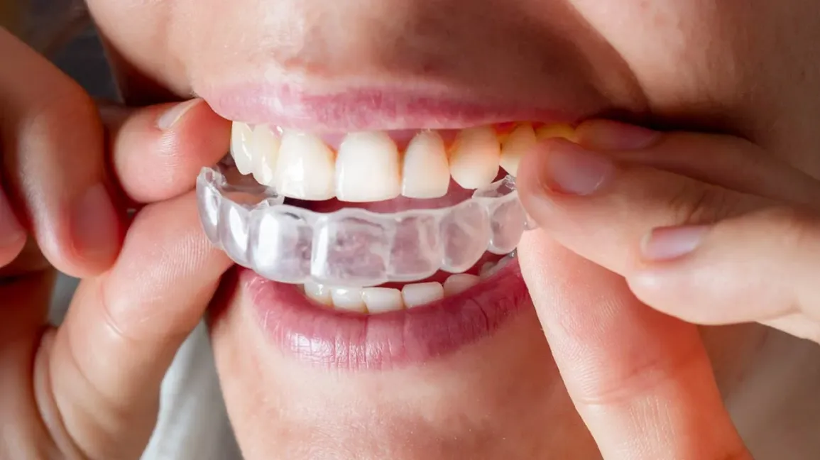 Invisalign: Elevating Dental Innovation with Invisible Precision